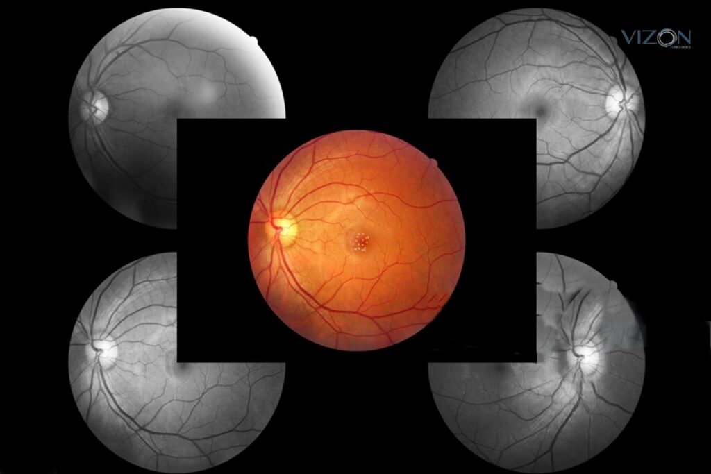 Degeneração Macular