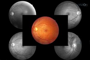 Degeneração Macular