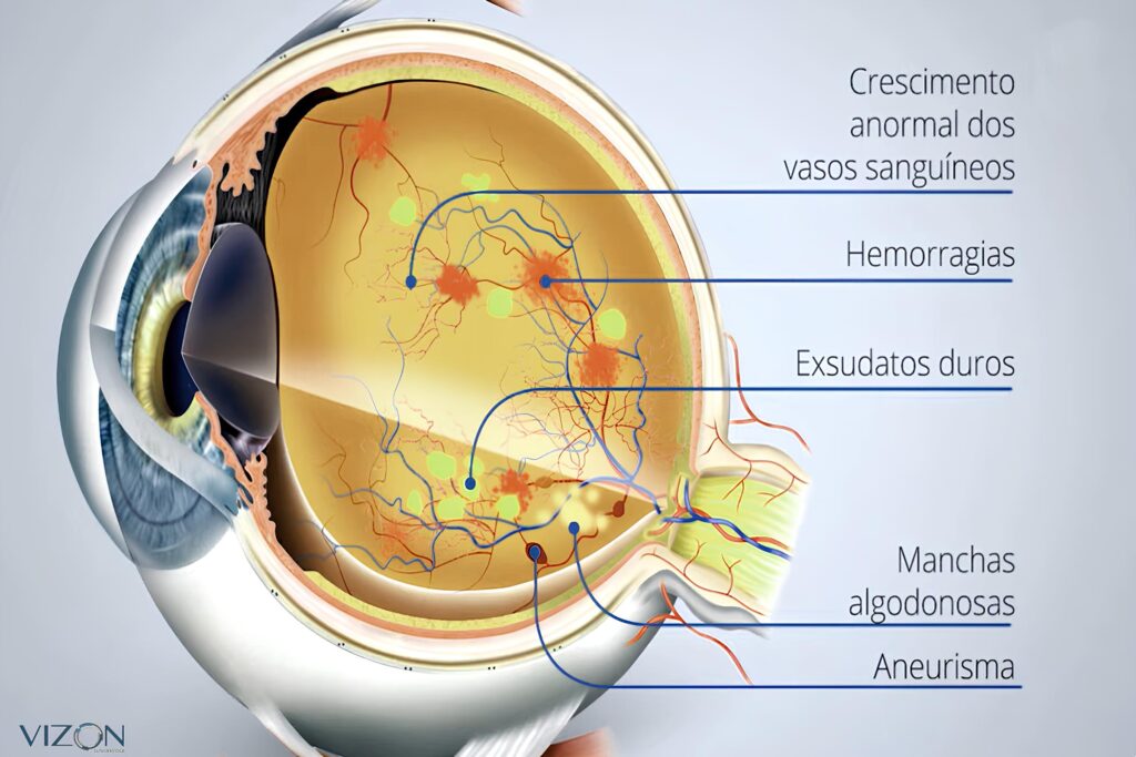 retinopatia diabetica hipertensiva