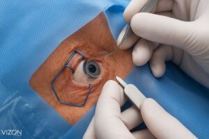 Cirurgia Refrativa pelo Convênio