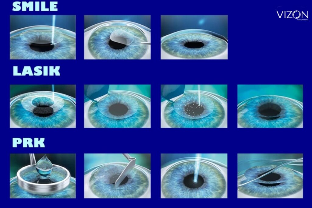 TIPOS DE CIRURGIAS REFRATIVA