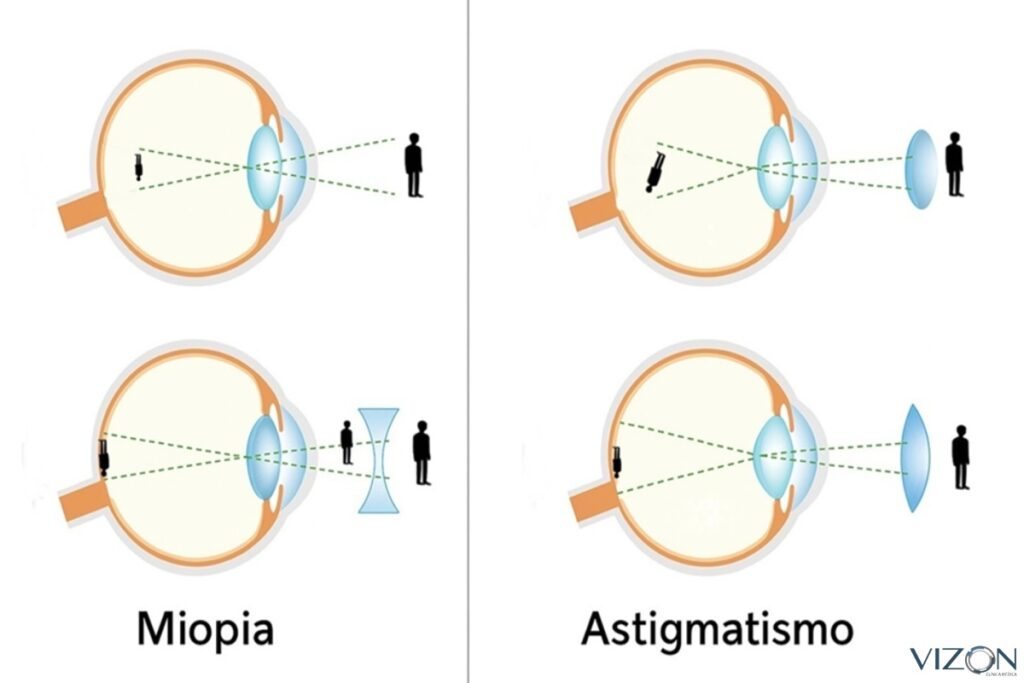 astigmatismo