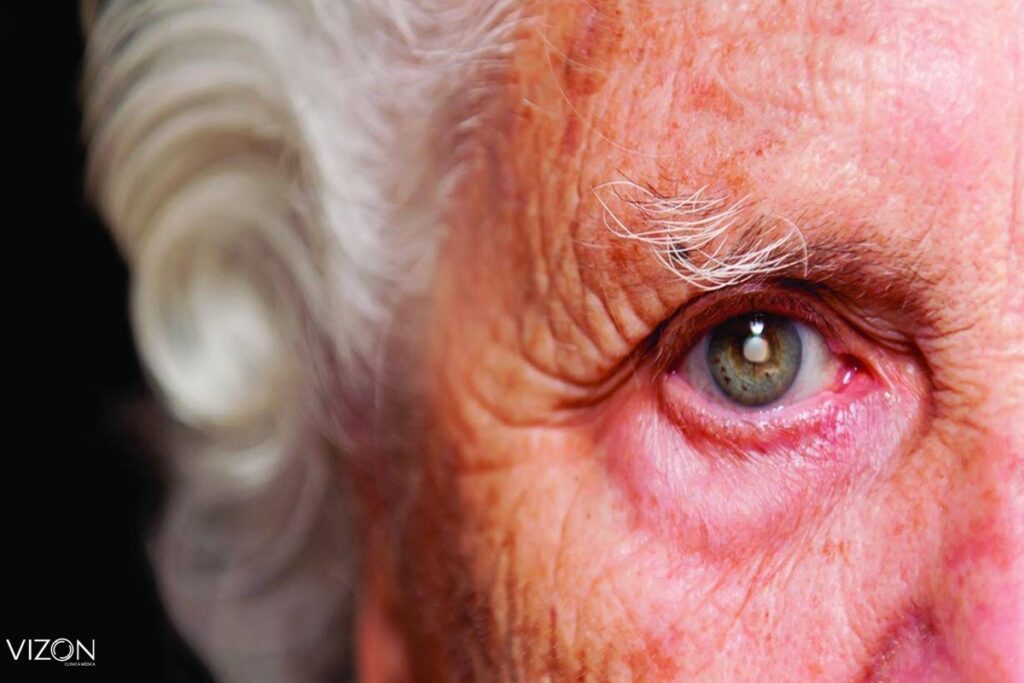 catara nos olhos