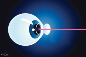 como é a cirurgia refrativa