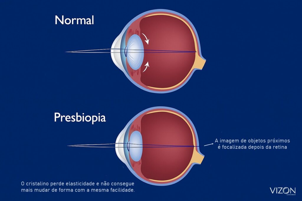 Presbiopia: o que é, sintomas de vista cansada e tratamento