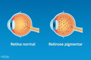 RETINOSE