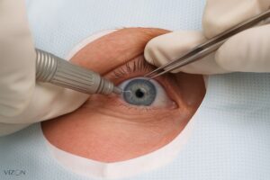 cirurgia refrativa