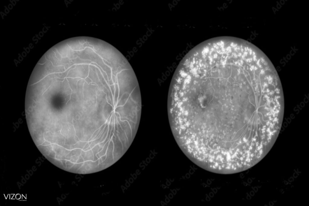 como tratar retinose pigmetar